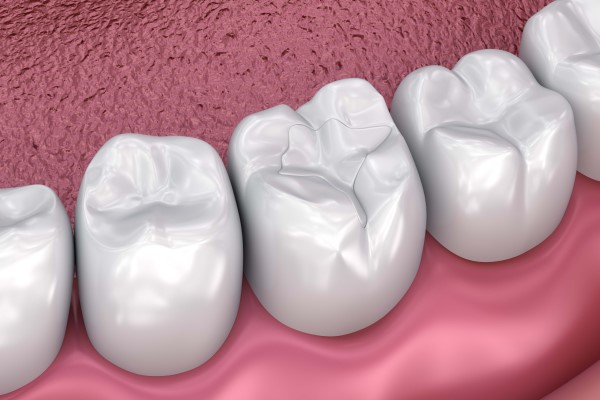 What Is A Temporary Dental Filling?